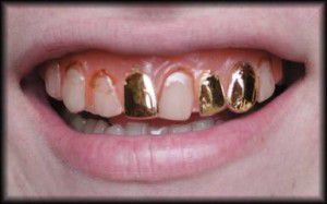 sc-CT230-PIxl-goldteeth