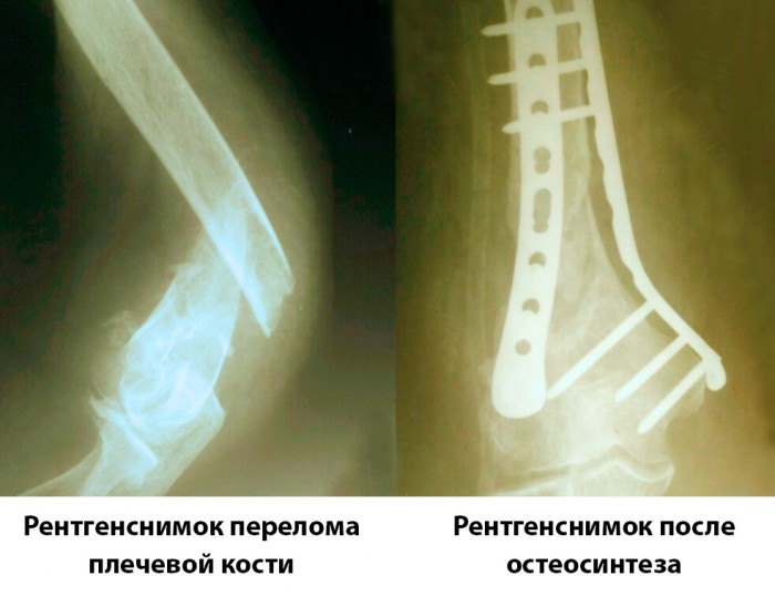 Рентгенснимок перелома руки пациентки и снимок после остеосинтеза