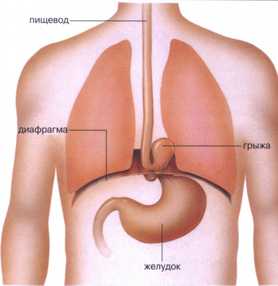 Схематическое изображение грыжи пищеводного отверстия дифрагмы (1)