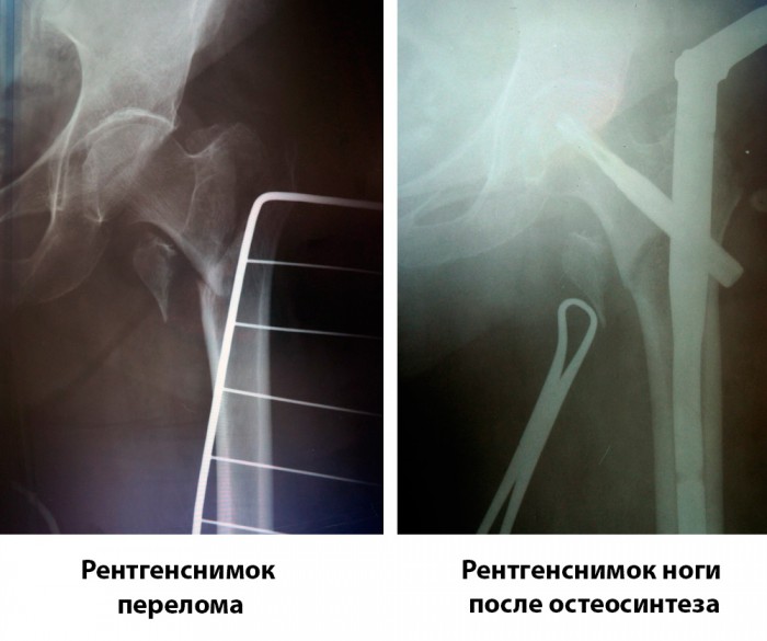 Фото 2_ Рентген-снимок до и после операции (1)