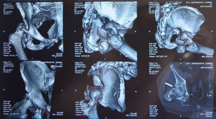 Фото 2_Компьютерная томография до операции
